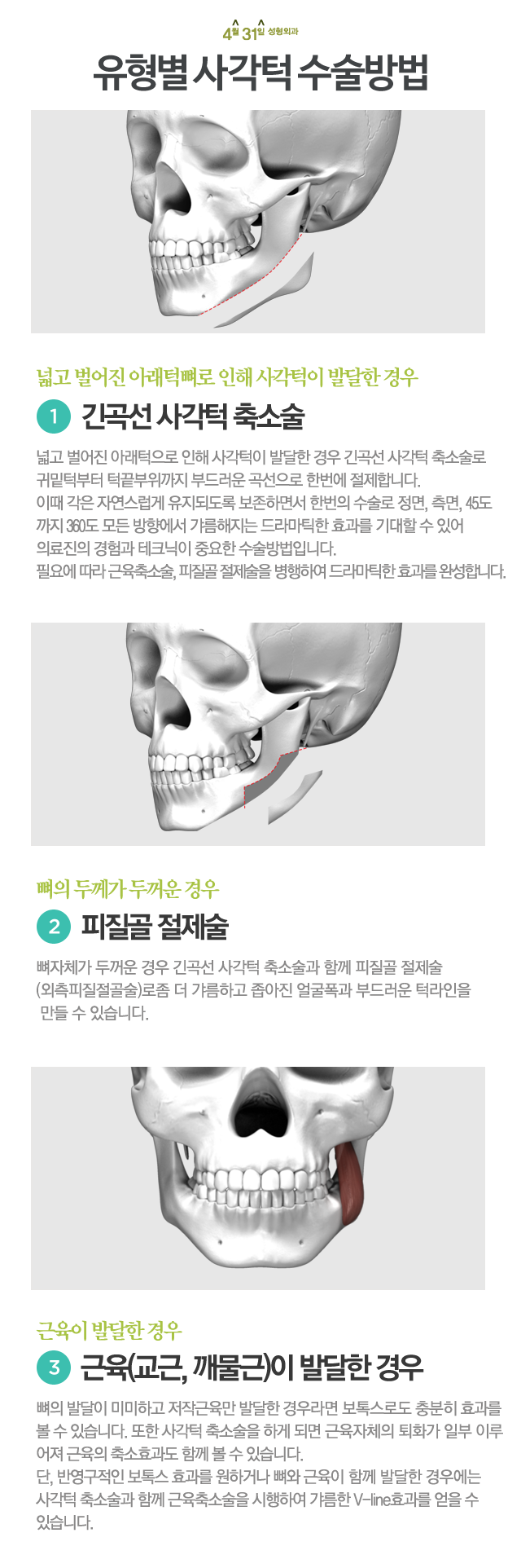 귀밑사각턱수술 4월31일성형외과의 1:1전담진료 관련 이미지 3