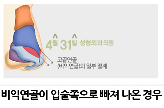 코길이축소 더 어려보이게 관련 이미지 5