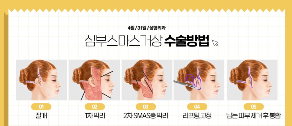 [Facelift] A lifting procedure beyond the limits of non-surgical treatments: 431 Plastic Surgery’s special lifting procedure image 8