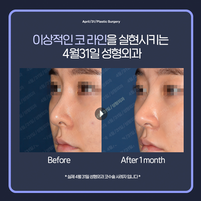 [코성형] 밸런스에 맞는 콧대길이 교정 관련 이미지 7