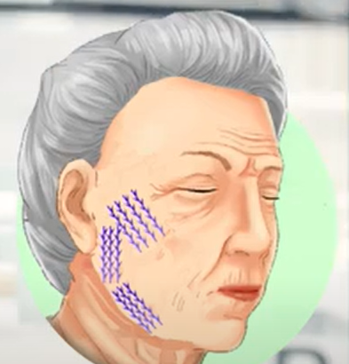 How to Get the Most Out of a Thread Lift + Self-Diagnosis Method image 4