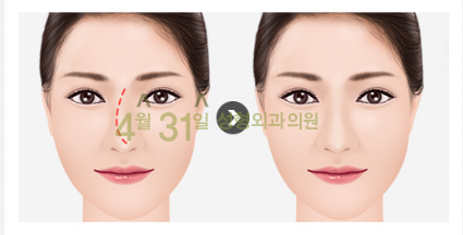 남자코재수술 4월31일성형외과의원에서 자연스럽게! 관련 이미지 2