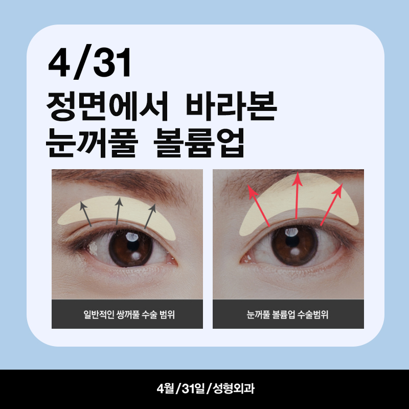 [Eyelid Volume Up] Take Another Look at Sunken Eyes! Eyelid Volume Up Surgery image 5