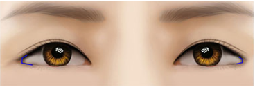 [Eye Revision Surgery] A Difference Made by a Small Detail image 9