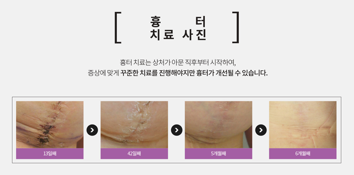 강남흉터치료 수술 흉터까지 4월31일성형외과 관련 이미지 3