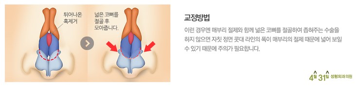 매부리코수술잘하는병원 추천 4월31일성형외과의원 관련 이미지 5