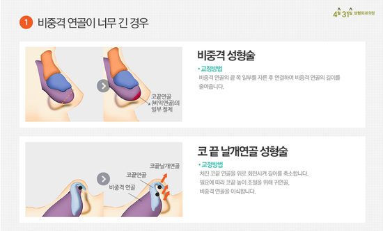 긴코수술 고민중이라면 4월31일성형외과의원 관련 이미지 2