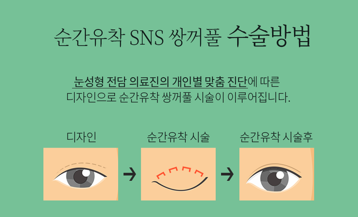 순간유착 쌍꺼풀은 4월31일성형외과 관련 이미지 2