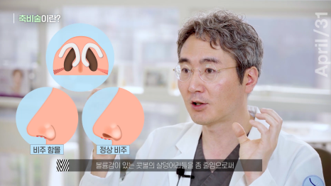 뭉툭한 코, 매부리코를 가지고 있다면 관련 이미지 6