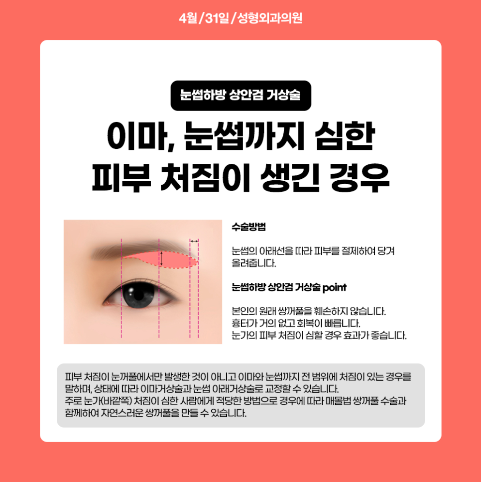 Let’s Look 10 Years Younger at a Place That Does Upper Blepharoplasty Well image 4