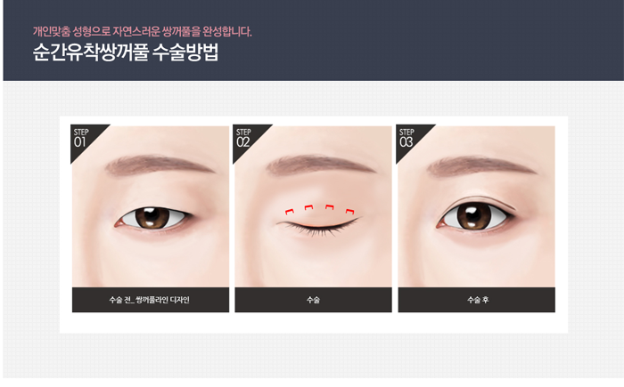 순간유착 4월31일성형외과 믿음 가는 이유 관련 이미지 5