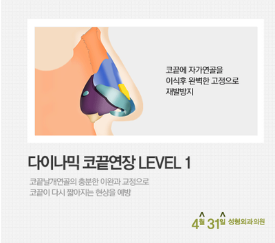들창코성형 재발 줄이는 4월31일성형외과의원 관련 이미지 2