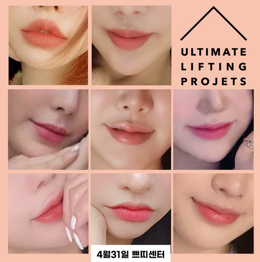 Creating Plump Cherry Lips at the Lip Spot (Lip Filler + Lip Corner Botox) image 9
