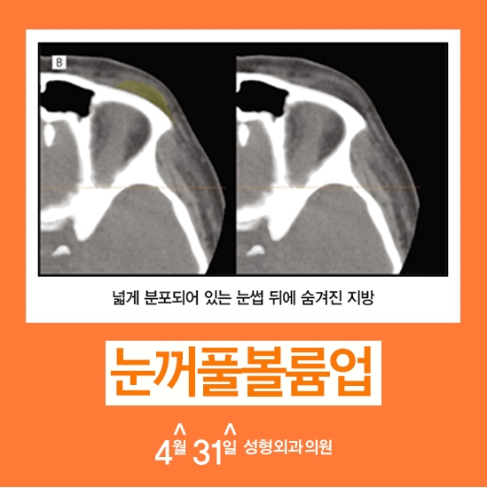 눈꺼풀처짐수술 눈꺼풀볼륨업으로 해결! 관련 이미지 3