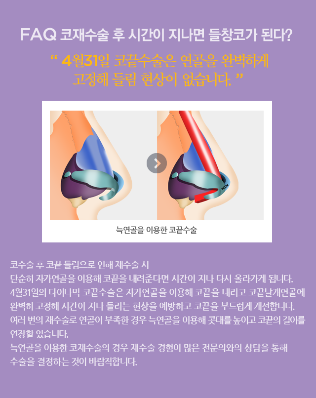 서울코재수술 들림현상 예방하는 4월31일성형외과의원 관련 이미지 2