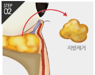 [Eye Plastic Surgery] Middle-Aged Eye Surgery to Improve Uneven Under-Eyes! Lower Blepharoplasty image 5