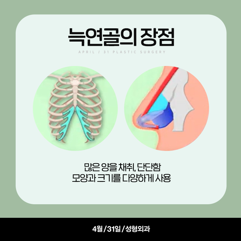 [구축코] 구축코 교정술 5단계 심층분석 Part03_이완시킨 연골 구조의 고정 관련 이미지 7