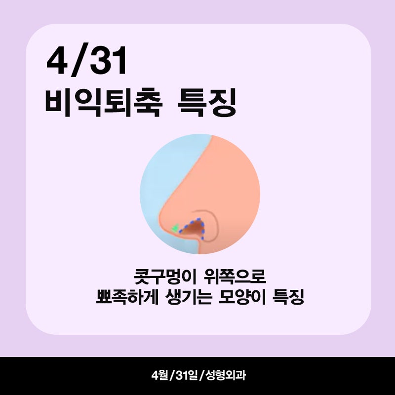 [코성형] 용코?비익퇴축술 파헤치기! 관련 이미지 4