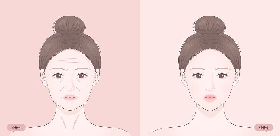실리프팅 효과 오래 유지하는 꿀팁 관련 이미지 3