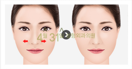 남자코재수술 4월31일성형외과의원에서 자연스럽게! 관련 이미지 3