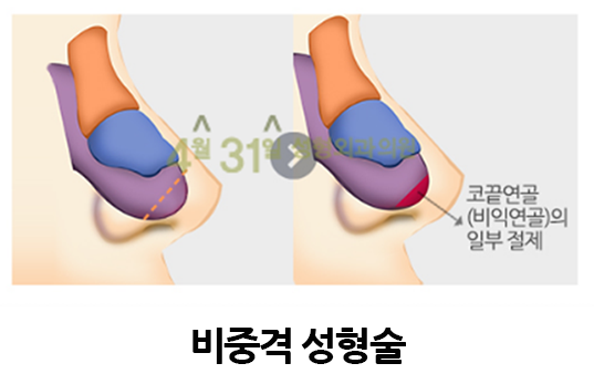 코길이축소 더 어려보이게 관련 이미지 3