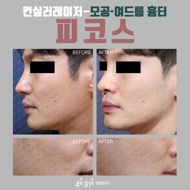 컨실러레이저 피코스레이저 모공축소레이저시술로 가능해 관련 이미지 5