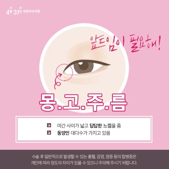 앞트임병원 추천 4월31일성형외과의원 관련 이미지 2