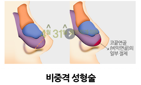 긴코교정 내 얼굴 밸런스에 맞는 코! 관련 이미지 2