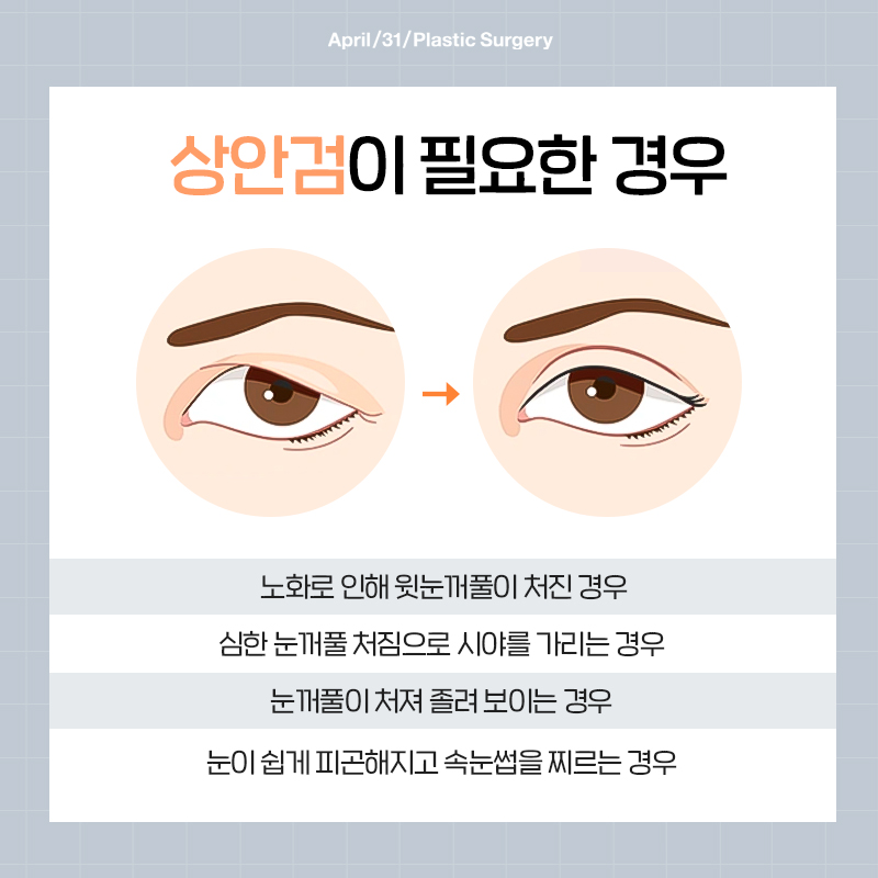 [눈성형] 처진 눈꺼풀 리프팅! 상안검 수술 관련 이미지 6