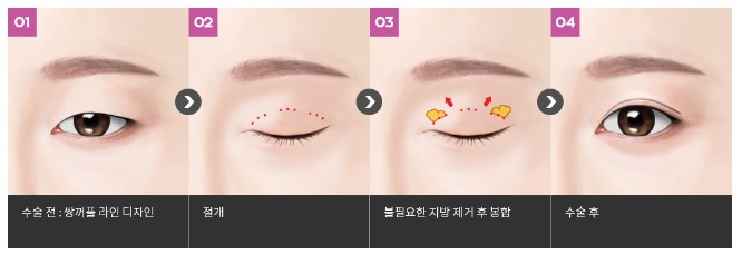[Eye Plastic Surgery] Is male eye surgery always too feminine? Key points for male double eyelid surgery! image 5