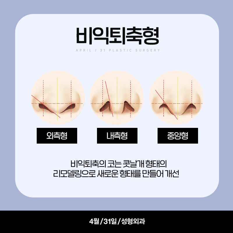 [Nose Surgery] Let Me Tell You the Secret of Nostril Reduction! image 3
