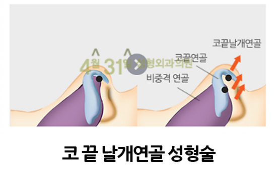긴코교정 내 얼굴 밸런스에 맞는 코! 관련 이미지 3