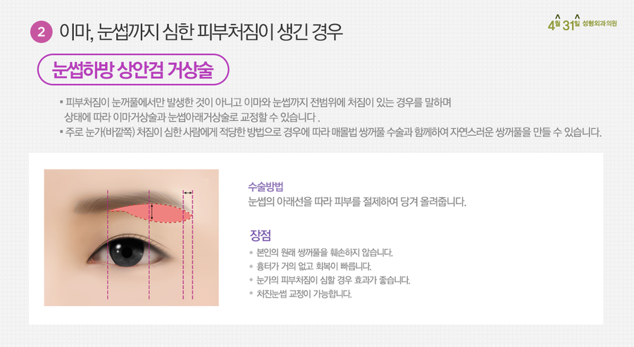 중년눈성형 상안검은 4월31일성형외과의원에서 관련 이미지 4