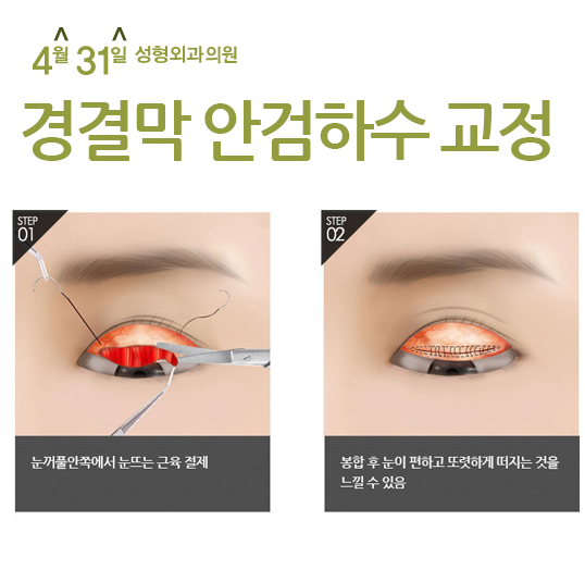 답답한눈매교정수술은 4월31일성형외과 관련 이미지 4
