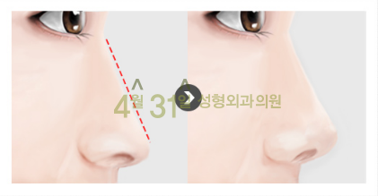 남자코재수술 4월31일성형외과의원에서 자연스럽게! 관련 이미지 6