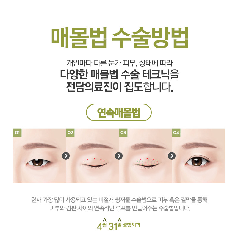쌍꺼풀수술잘하는곳 내가 찾던 바로여기! 관련 이미지 4