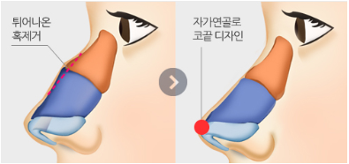 [코성형] 날카로운 인상을 세련되게 만들어주는 관련 이미지 7