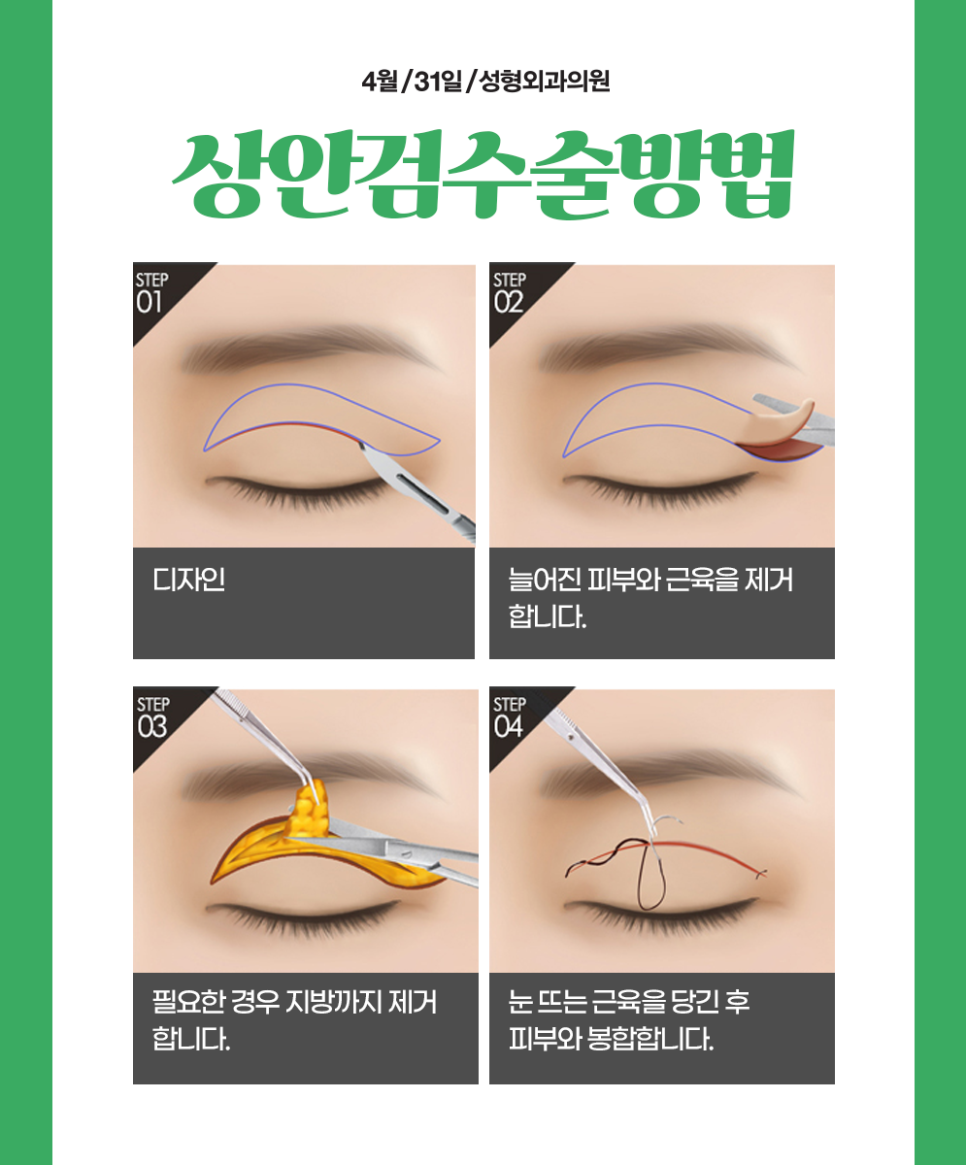 Recommended Middle-Aged Eye Surgery: Upper Blepharoplasty to Make Aging Eyes Look Youthful image 3