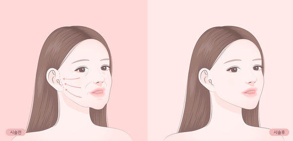 Thread Lifting Effects and How to Look 10 Years Younger (+ Filler, Shrink, Botox) image 2