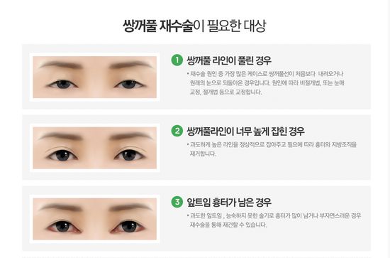 쌍꺼풀재수술병원 하나하나 따져봐도 4월31일성형외과의원 관련 이미지 1