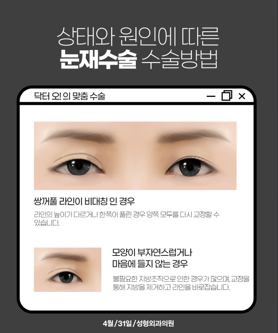 쌍꺼풀재수술유명한병원 후회없는 곳으로 관련 이미지 4