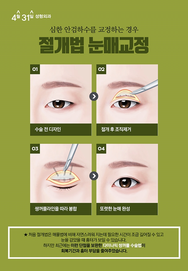 눈매교정잘하는곳 나에게 어울리게 4월31일성형외과 관련 이미지 5