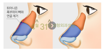 매부리코교정 확실하게 4월31일성형외과에서 관련 이미지 4