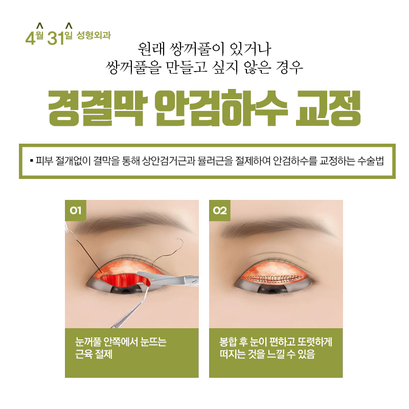 강남눈매교정술 4월31일성형외과의 노하우! 관련 이미지 4