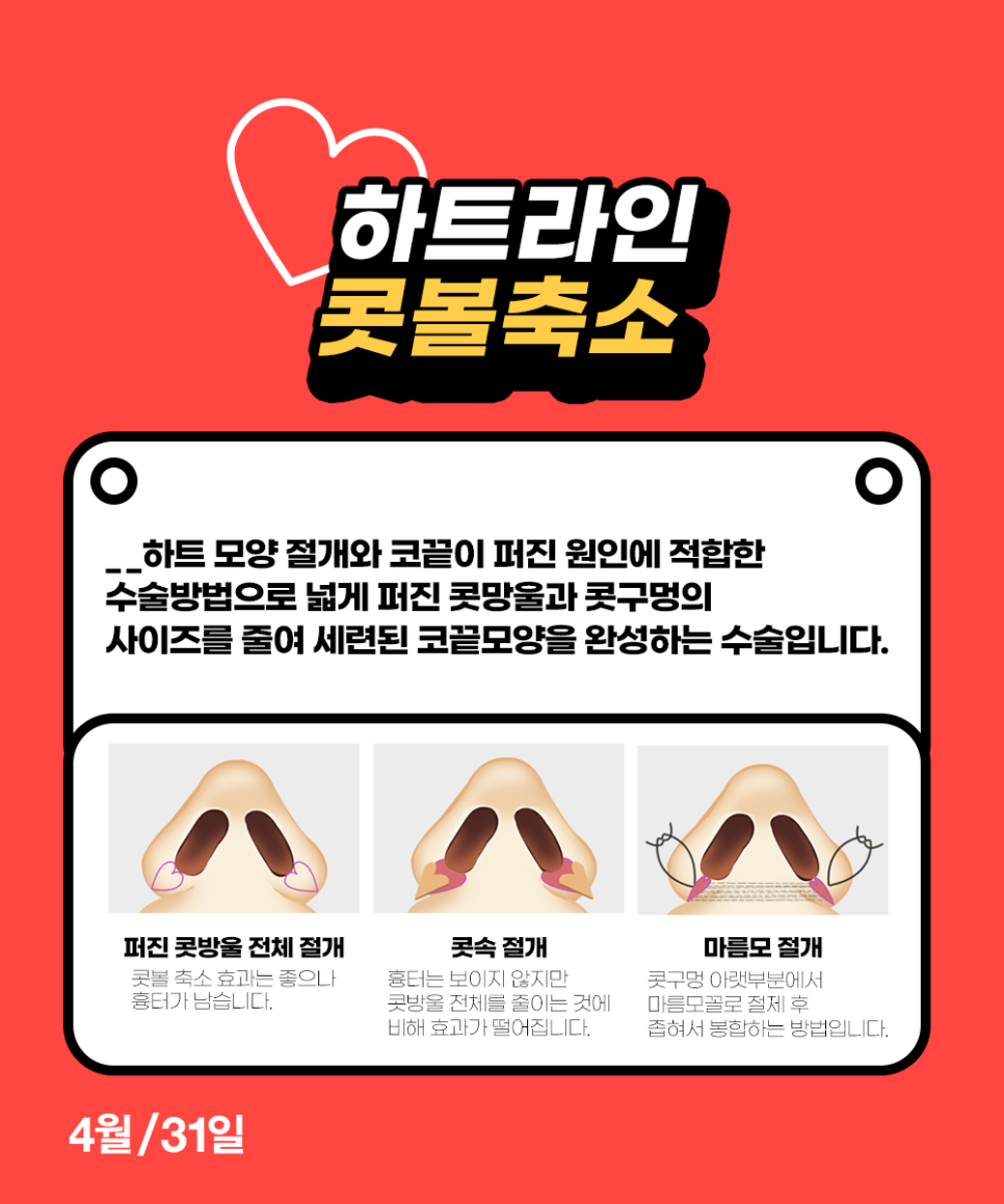 콧볼축소수술잘하는곳 4월31일성형외과에서 받고 얄쌍하게! 관련 이미지 2