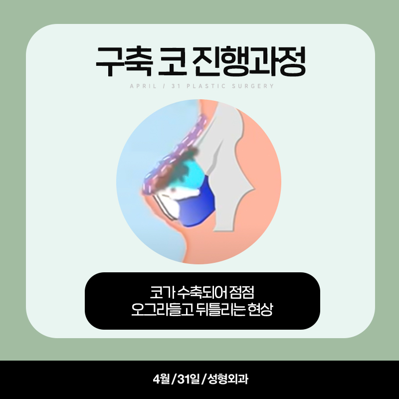 [Contracted Nose] Deep Analysis of the 5 Steps of Contracted Nose Correction Part 02_Separation of the Cartilage Structure and Relocation to the Correct Position image 3