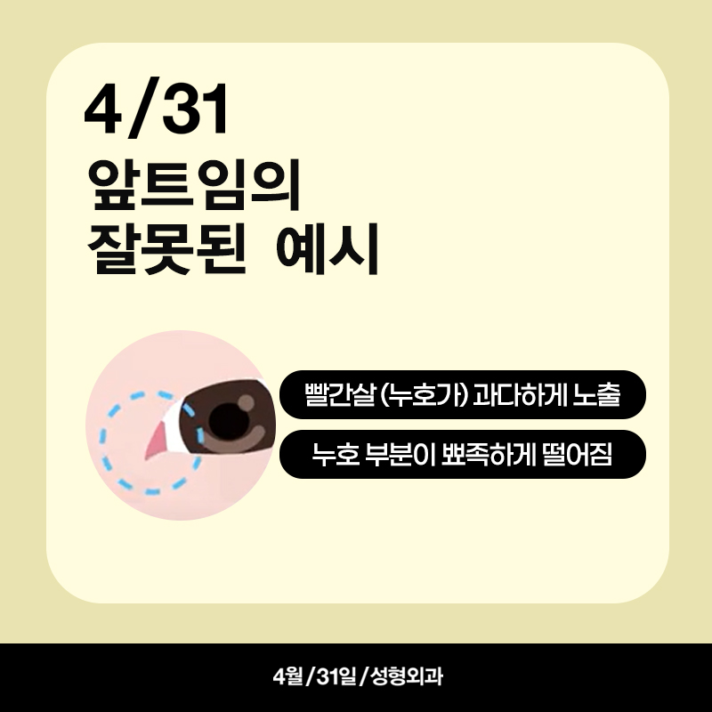 [Eye Revision Surgery] A Difference Made by a Small Detail image 6