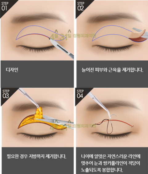 상안검수술 4월31일성형외과의원에서 자연스럽게 관련 이미지 2
