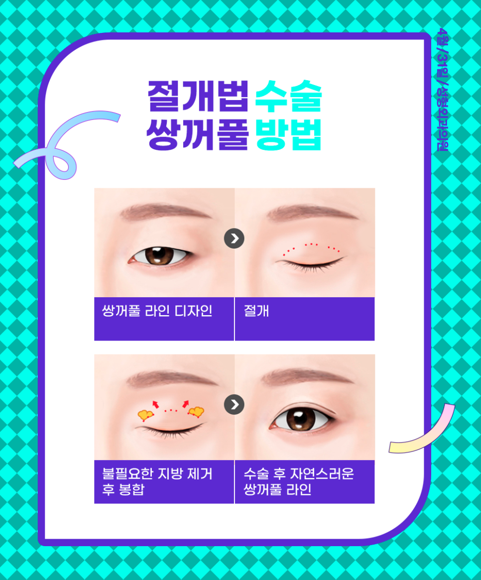 Find Your Lifelong Line with a Director Who Has Over 22 Years of Experience at a Hospital That Specializes in Double Eyelid Surgery image 3