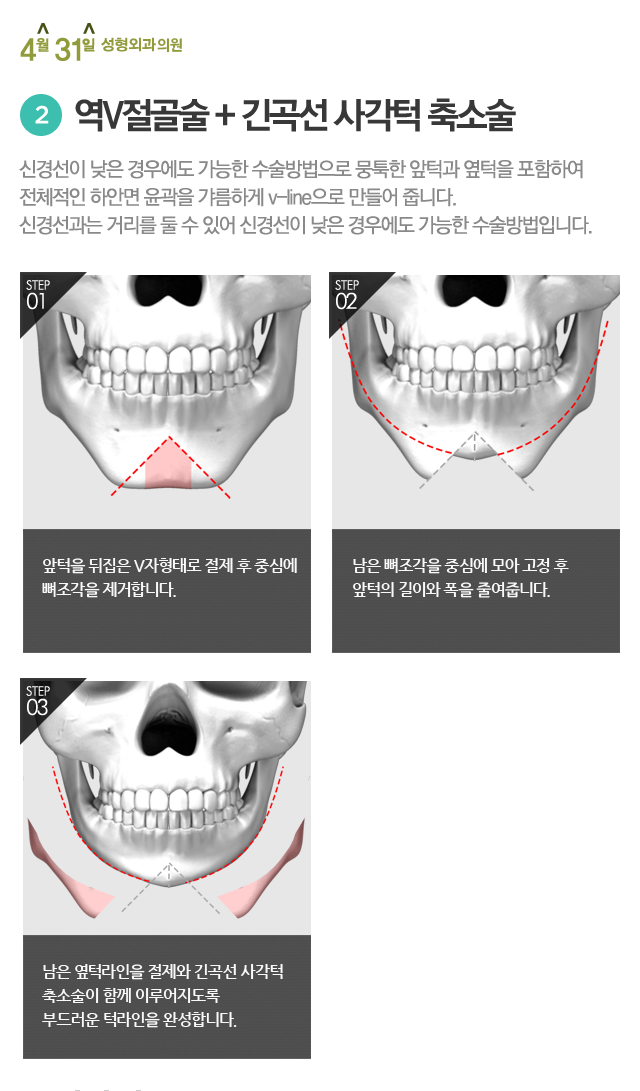 얼굴크기줄이기 4월31일성형외과의원에서 알려드려요 관련 이미지 3